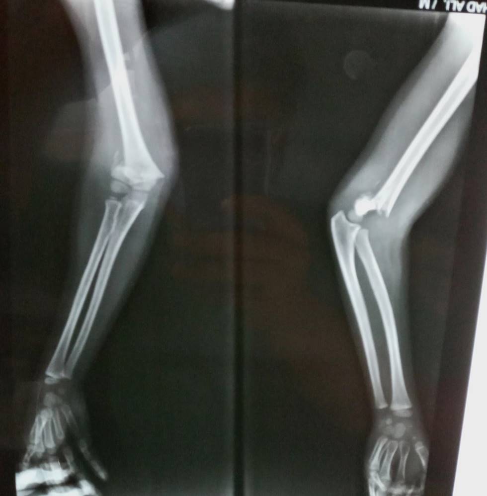 supracondylar fracture humerus