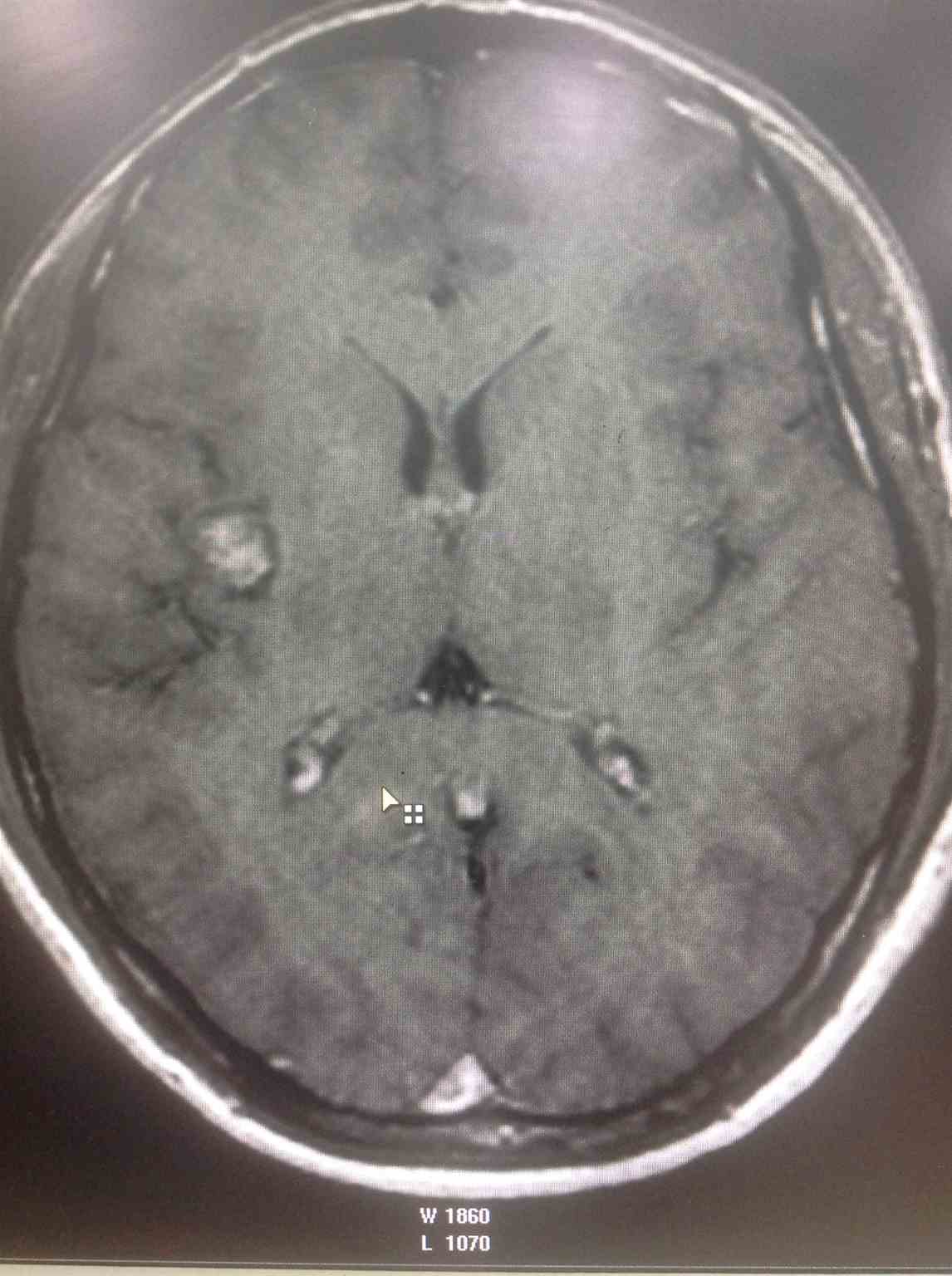 <p>Postcontrast T1-Weighted Image. Image shows absence of any associated developmental venous anomaly.</p>