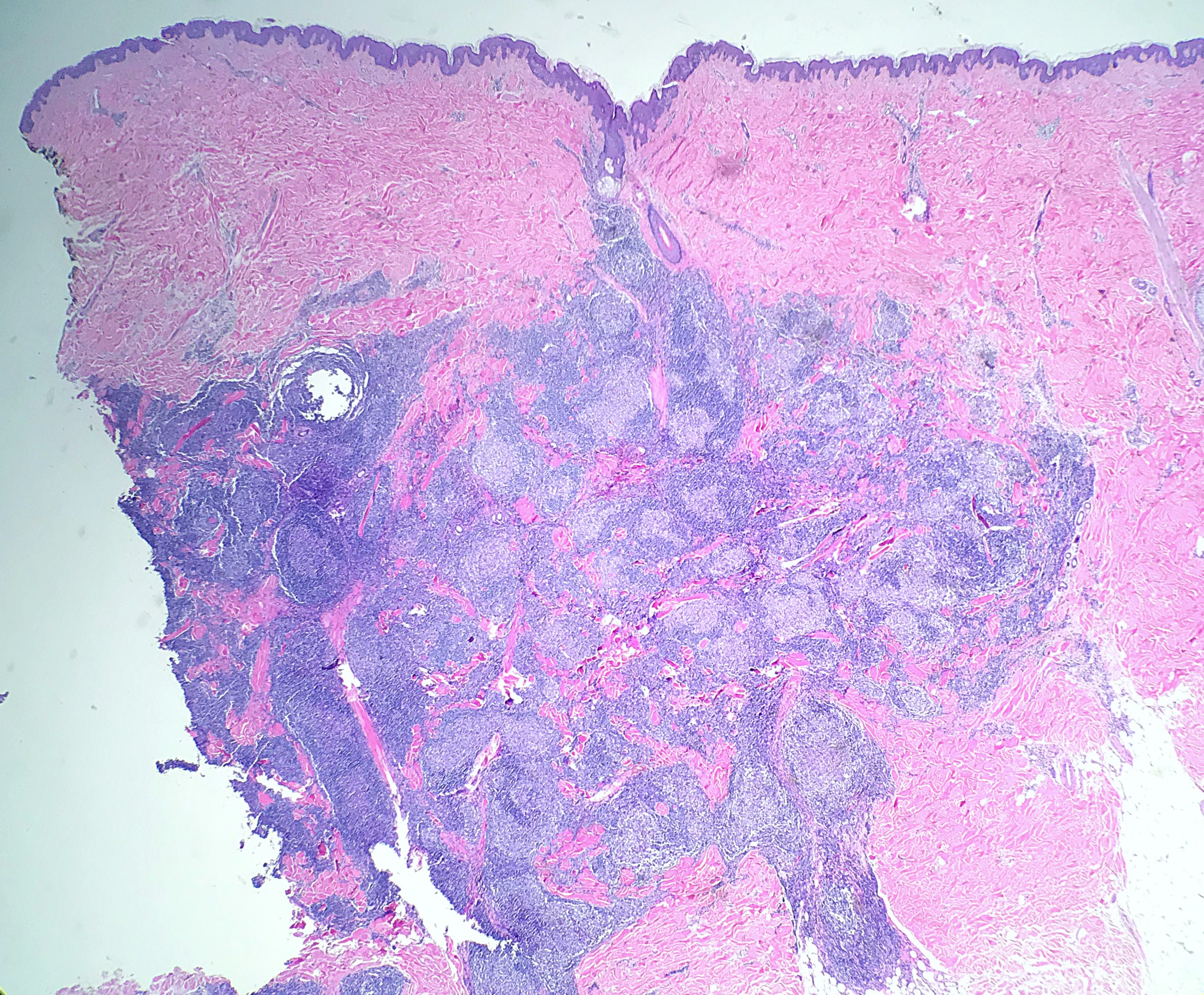 <p>Primary Cutaneous Follicle Center Lymphoma. PCFCL demonstrates&nbsp;densely packed follicles in skin shave biopsy.</p>