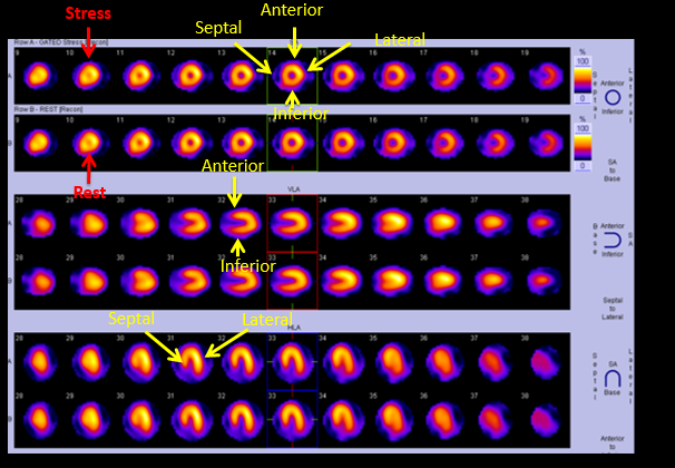 Normal myocardial perfusion scan showing location of segments