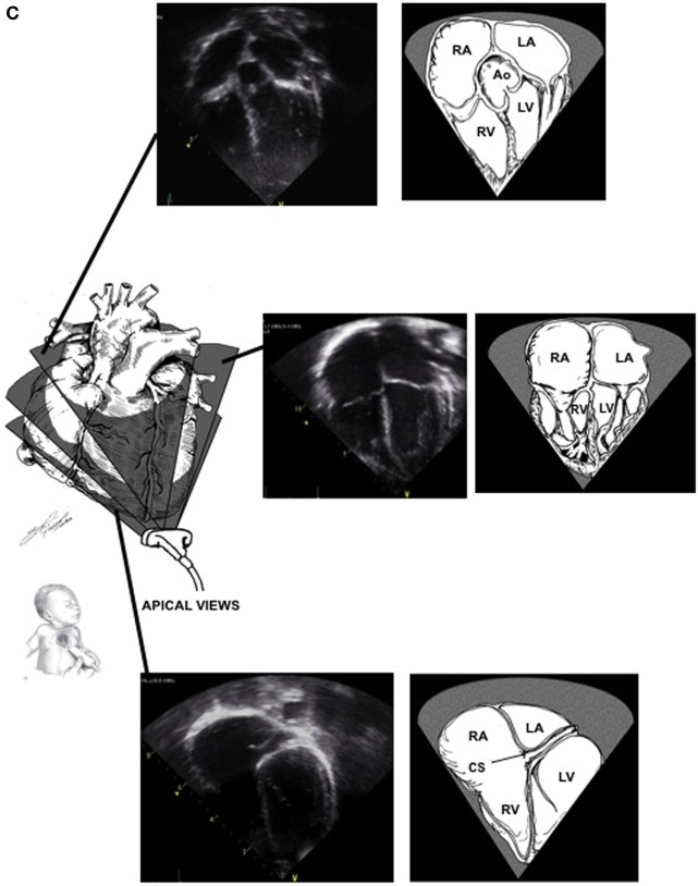 Pediatric TTE Apical Windows.