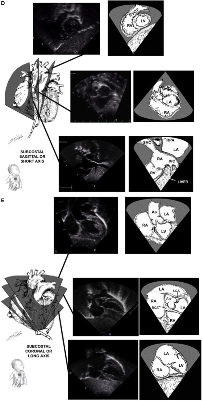 Pediatric TTE Subcostal Window.