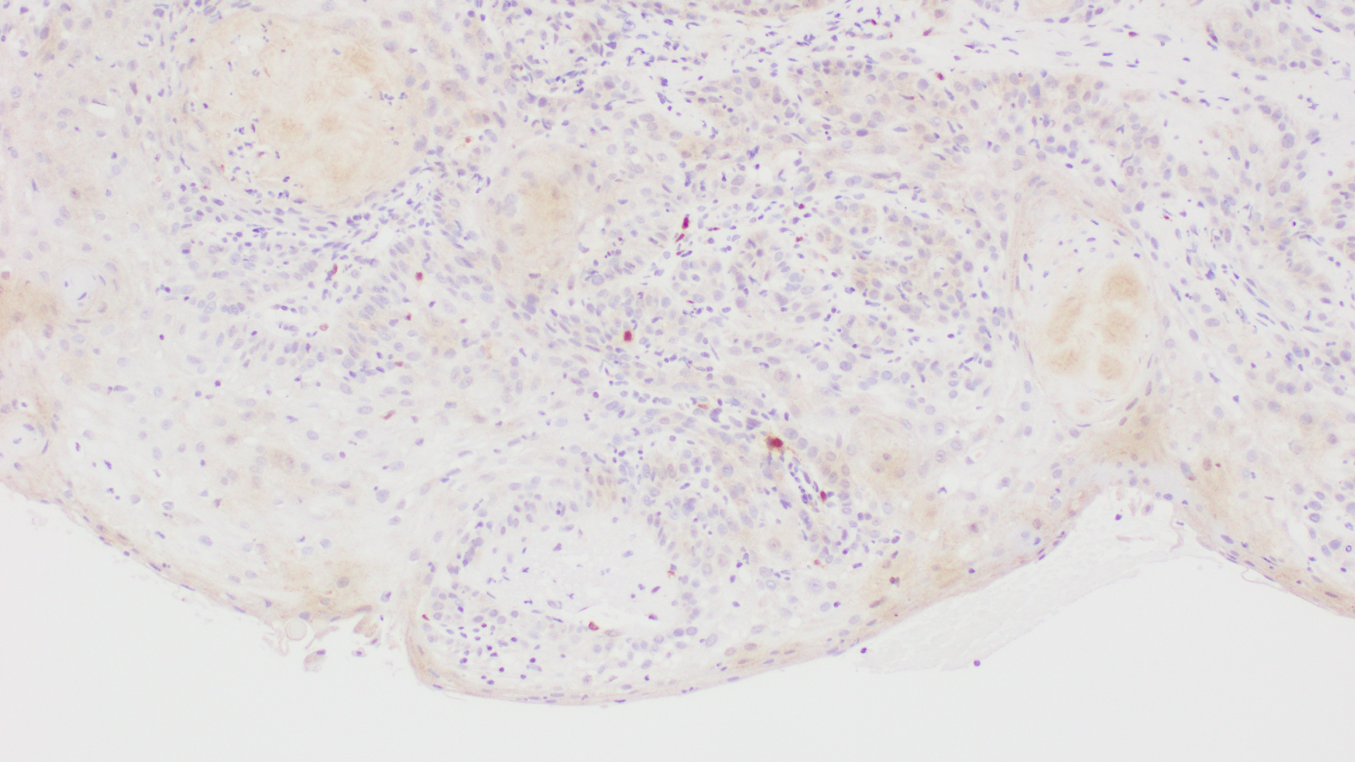 <p>Human Papillomavirus (HPV 16)