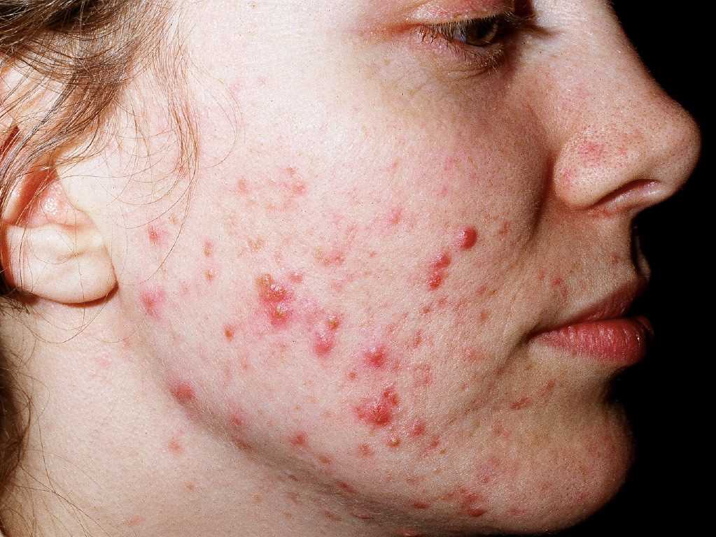 <p>Acne Vulgaris</p>