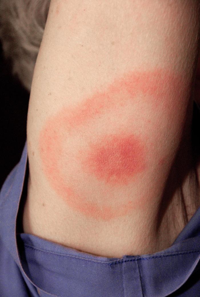 <p>Lyme Disease "Bulls-Eye" Rash.</p>