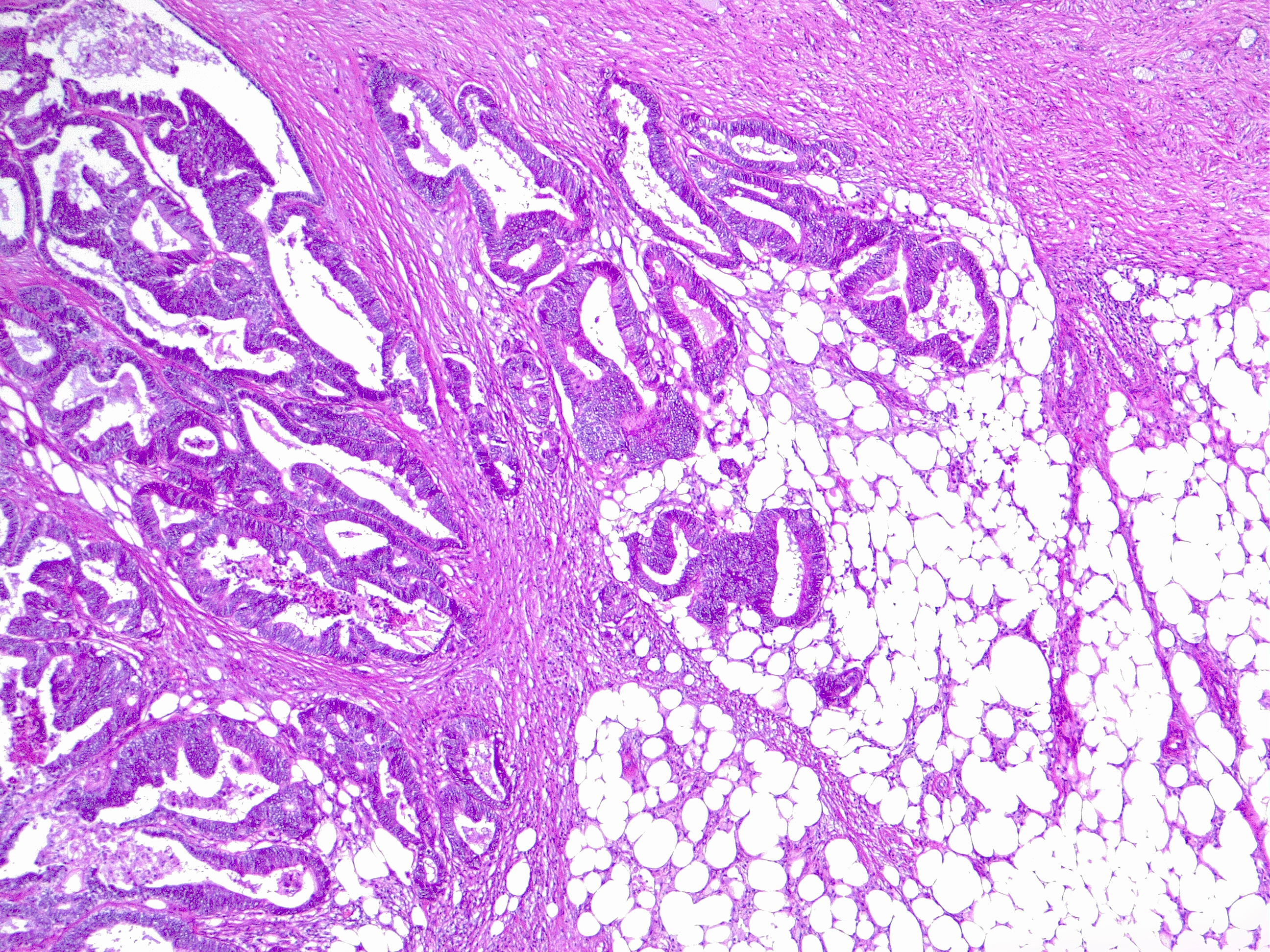 <p>Colorectal Cancer with Pathological T3 Staging