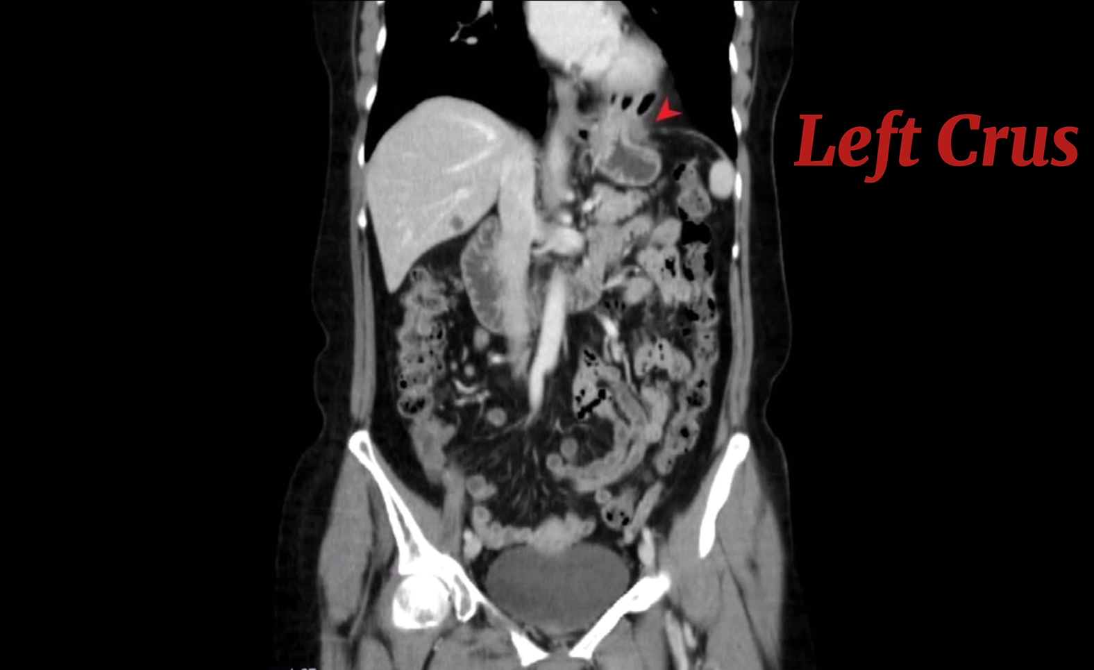 <p>Left Crus of Diaphragm, Coronal View