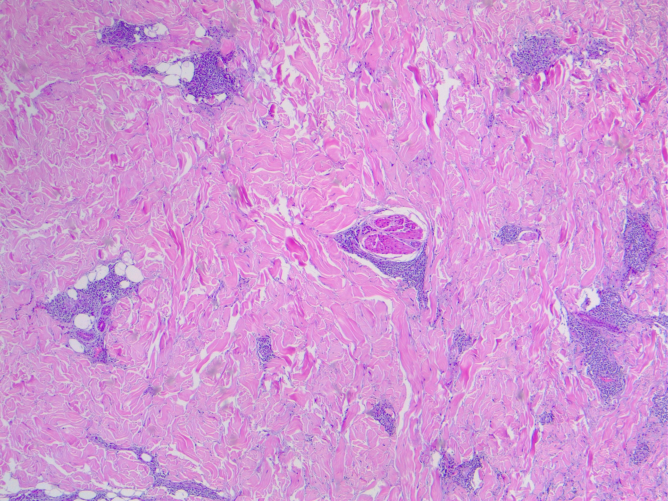 Dermatitis with selective pilosebacous unit involvement