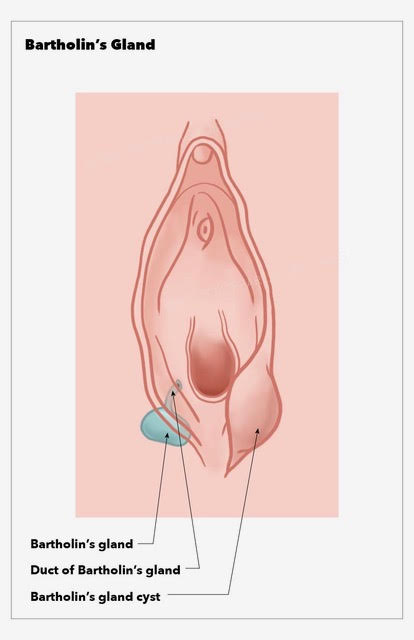 Bartholin's Gland Cyst