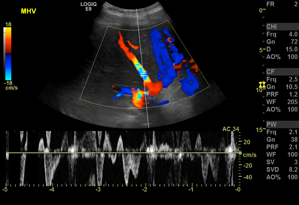 <p>Aliasing Artifact. The image is a hepatic venous Doppler ultrasound showing an aliasing artifact.</p>