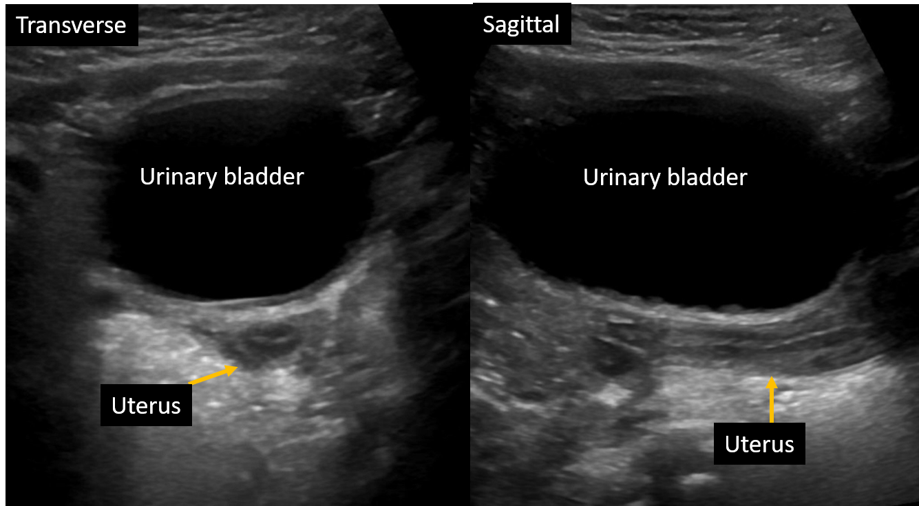 <p>Transabdominal Ultrasound, Normal Tubular-Shaped Uterus in a 2-Year-Old Female