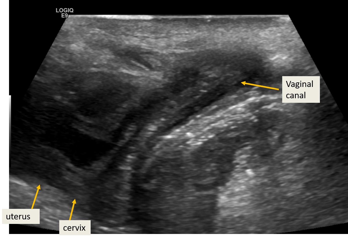 <p>Translabial Ultrasound of a 2-Year-Old Female