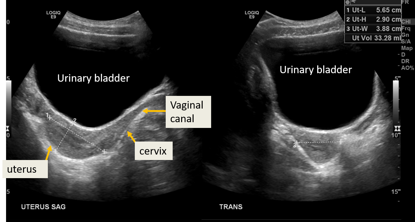 <p>Normal Transabdominal Ultrasound of the Uterus in a 17-Year-Old Female