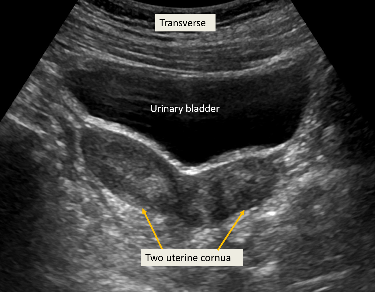 <p>Transabdominal Ultrasound of Uterine Didelphys.&nbsp;Two uterine cornua are visible in transverse sections.</p>