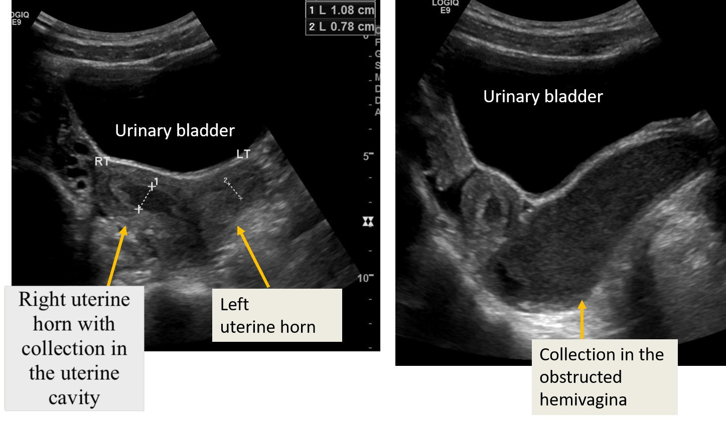 <p>Obstructed Hemivagina, Ipsilateral Renal Anomaly