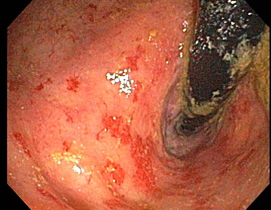 <p>Colonoscopy of Radiation Proctitis, Moderate-to-Severe</p>