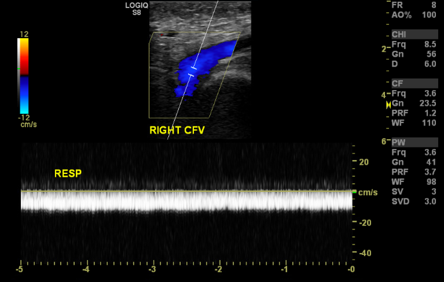 <p>Color Doppler Depicting Loss of Phasicity in the Common Femoral Vein.</p>