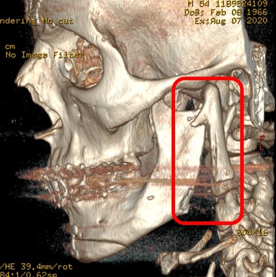 Iatrogenic vertical fracture of the mandibular ramus, extending through the sigmoid notch, that occurred during reduction of the mandibular angles during facial feminization