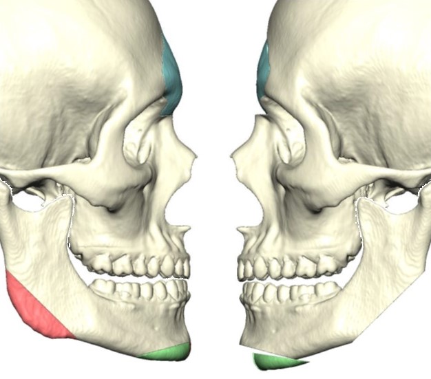 Surgical simulation based on 3-dimensional rendering of preoperative CT scan demonstrating planned reductions in frontal bossing, mandibular angle, and chin projection