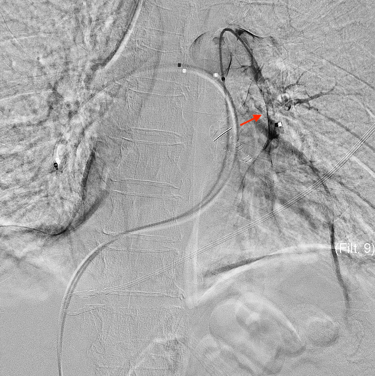 <p>Pulmonary Angiography Indicating&nbsp;Pulmonary Embolism