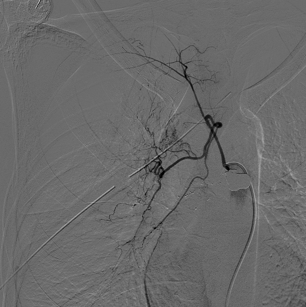 <p>Selected Catheterization Angiography, Right Bronchial Artery</p>