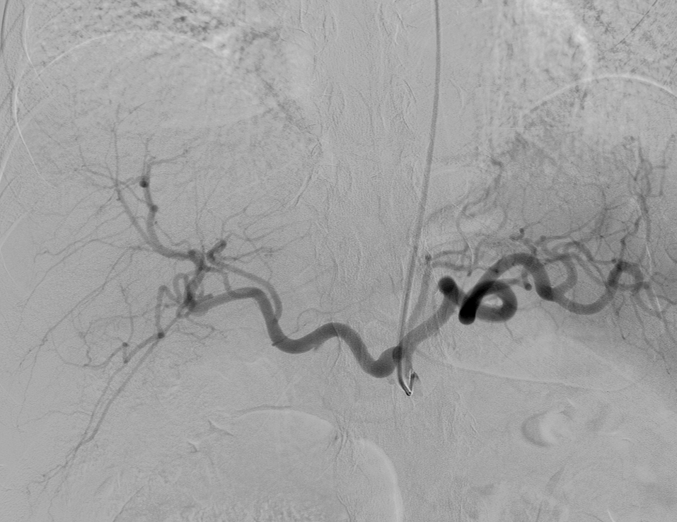 <p>Fluoroscopy-Guided Angiography With Selective Catheterization of the Celiac Artery</p>