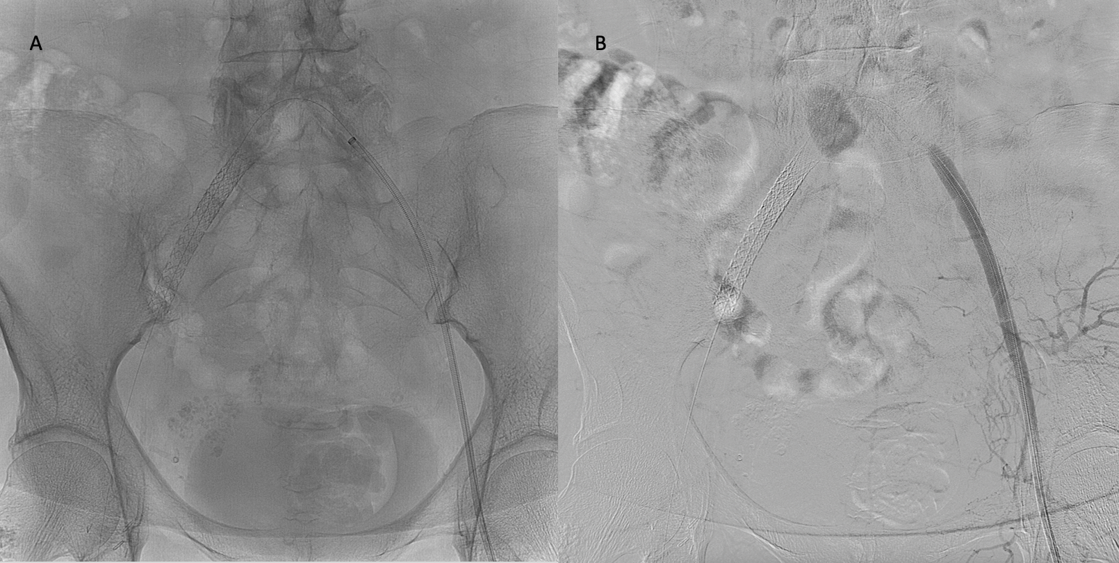 <p>Normal Fluoroscopy, Digital Subtraction Angiography