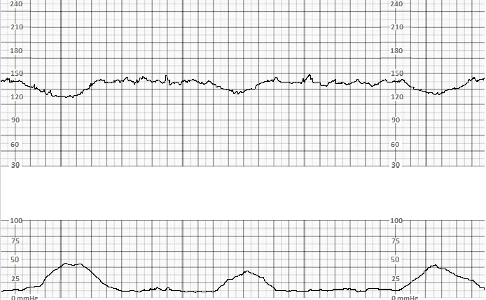 <p>Early Decelerations</p>