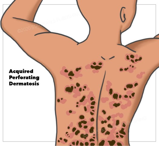 <p>Acquired Perforating Dermatosis</p>