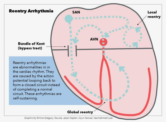 Reentry Arrhythmia, Bundle of Kent bypass tract, SAN, AVN, global reentry