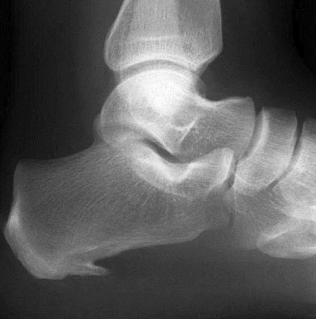 <p>Lateral Radiograph, Heel Spur