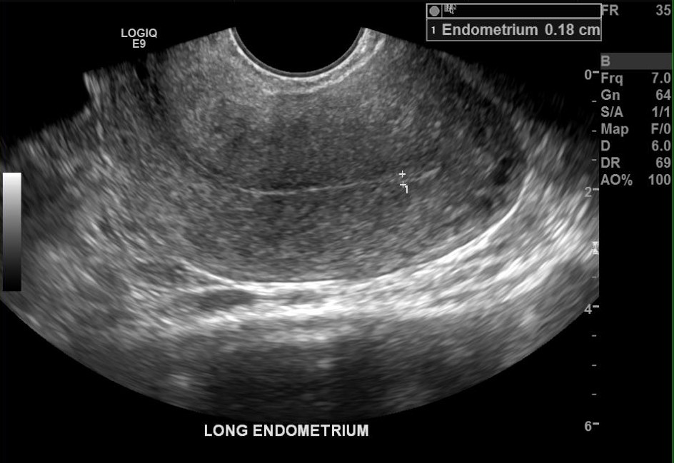 The semicircular region in the superior portion of the image indicates that this is a transvaginal ultrasound