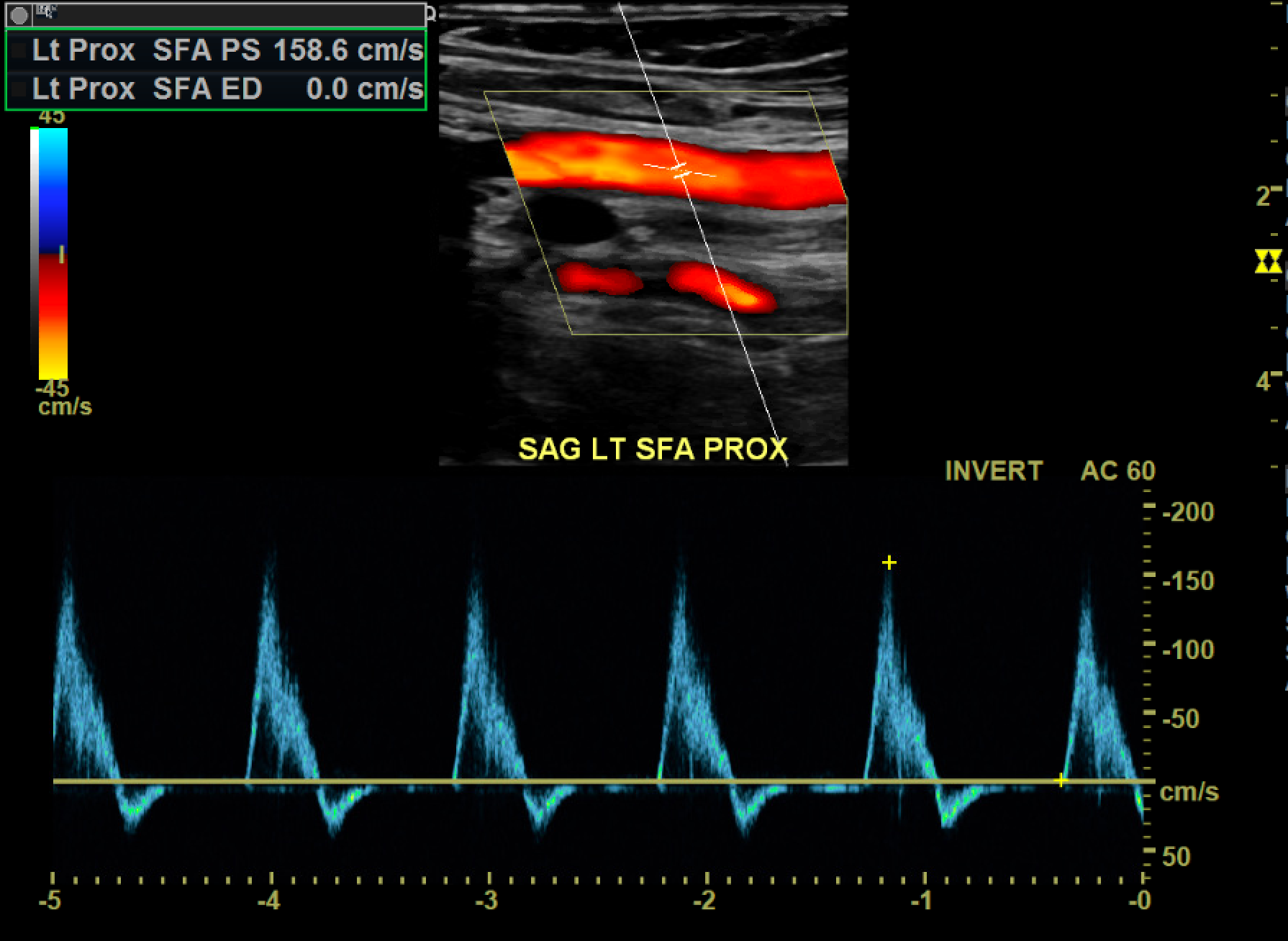 Normal Triphasic Arterial Waveform