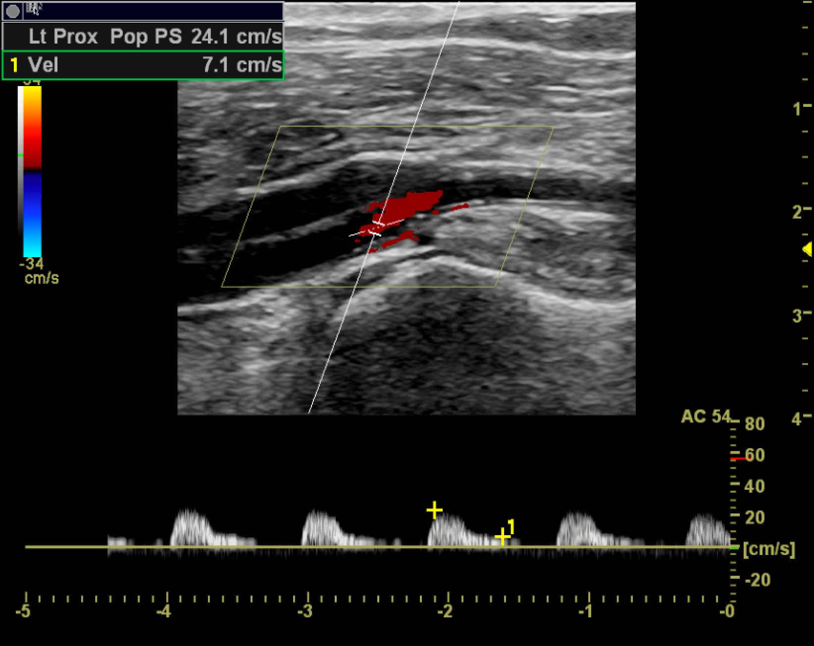 Monophasic Tardus and Parvus Waveforms