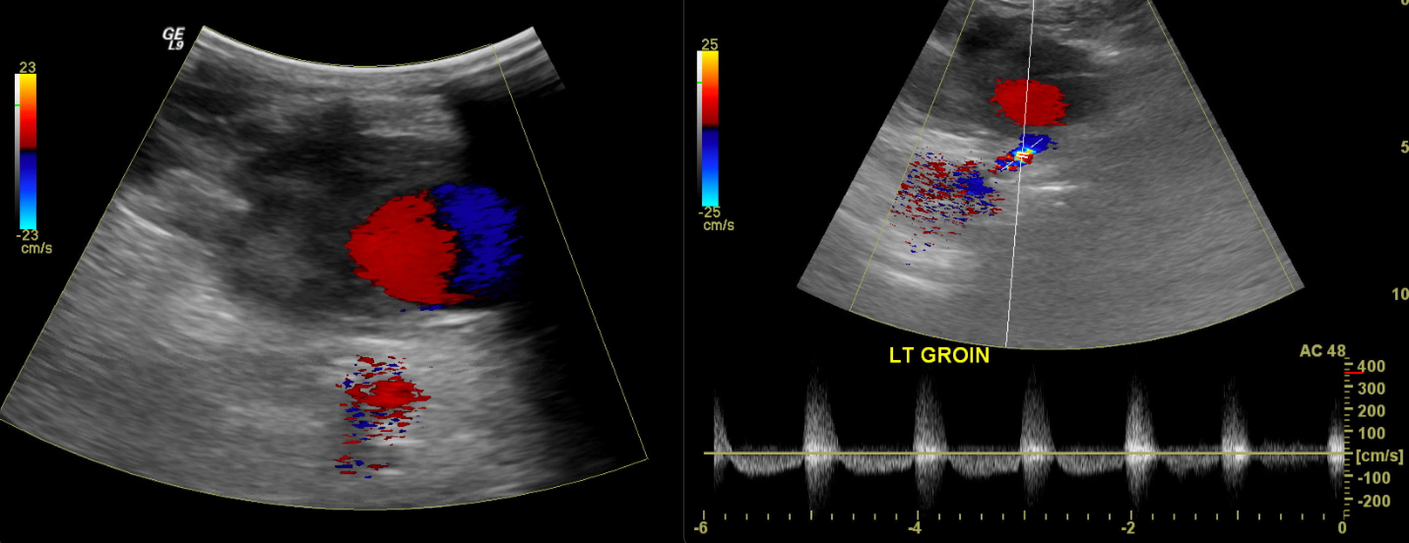 Pseudoaneurysm
Note the classic bidirectional 'yin-yang' color flow within the pseudoaneurysm and the to-and-fro flow in the neck