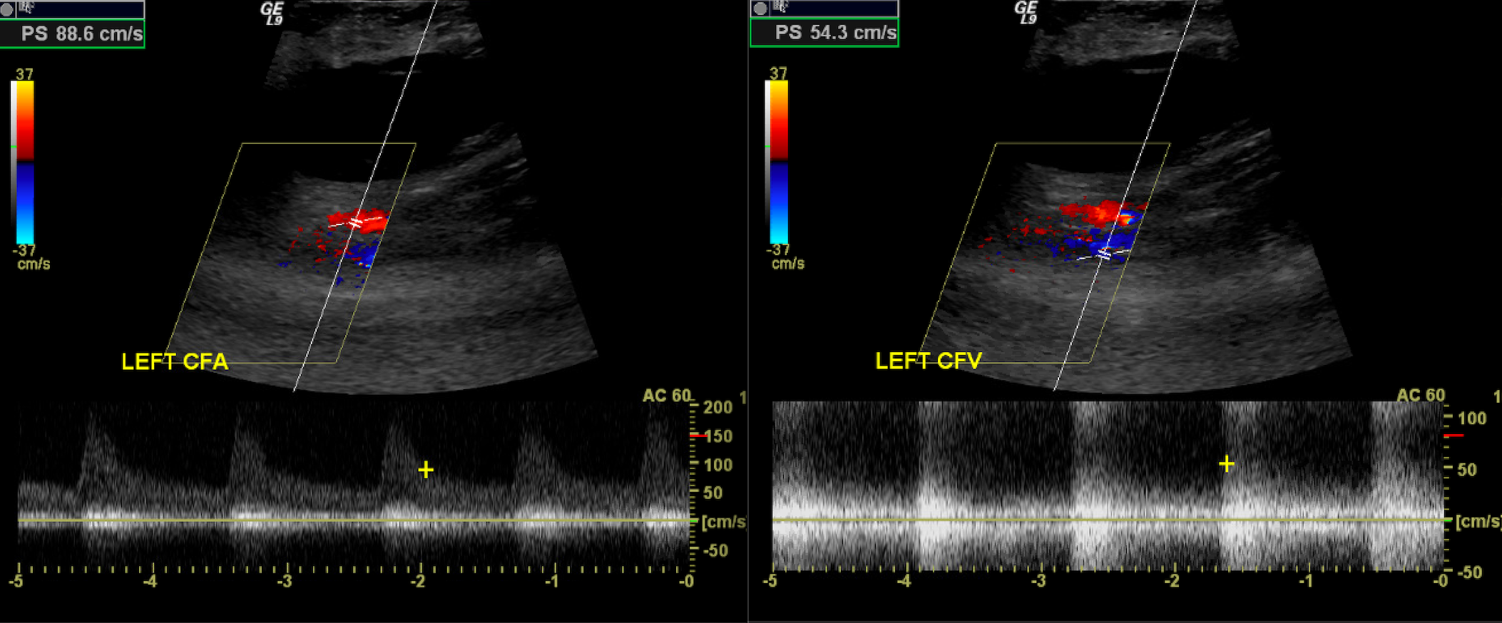 Arteriovenous Fistula
Note the low-resistance arterial wave forms with continuous , forward diastolic flow and the 'arterialization' of the venous waveforms