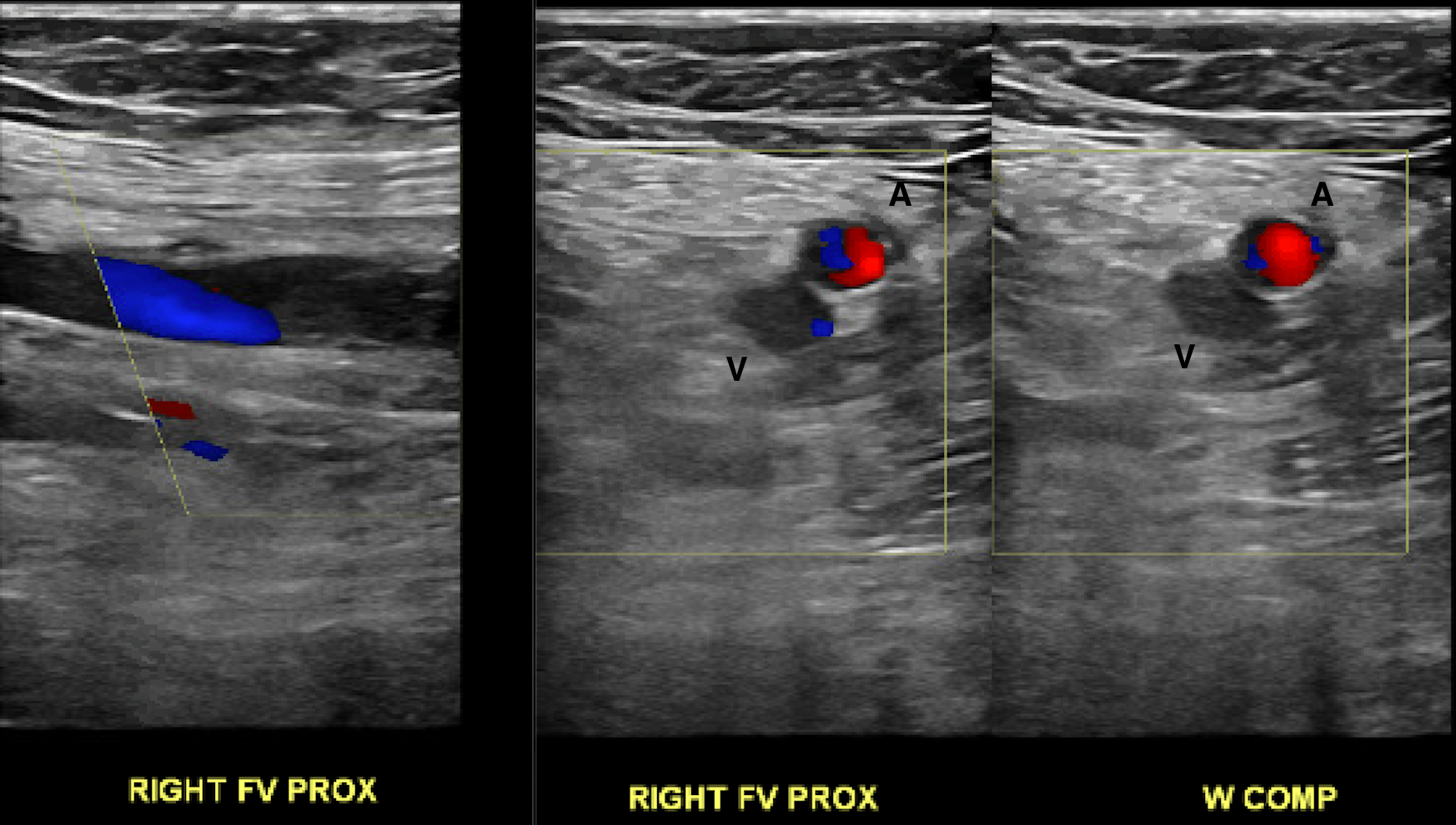 <p>Acute, Occlusive Deep Venous Thrombosis