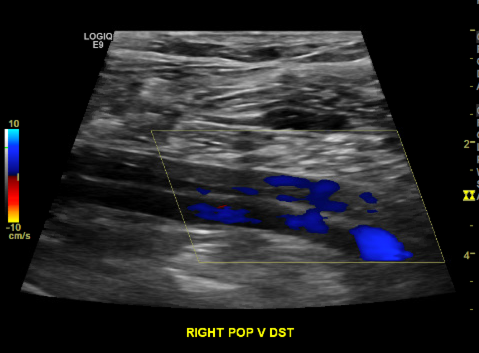 <p>Chronic Nonocclusive DVT Within a Duplicated Popliteal Vein