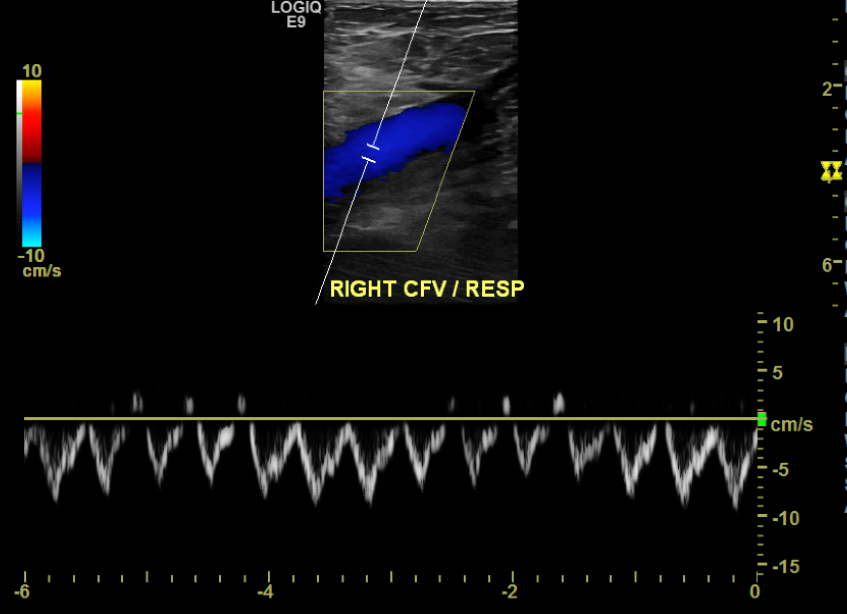 <p>Normal Respiratory Phasicity