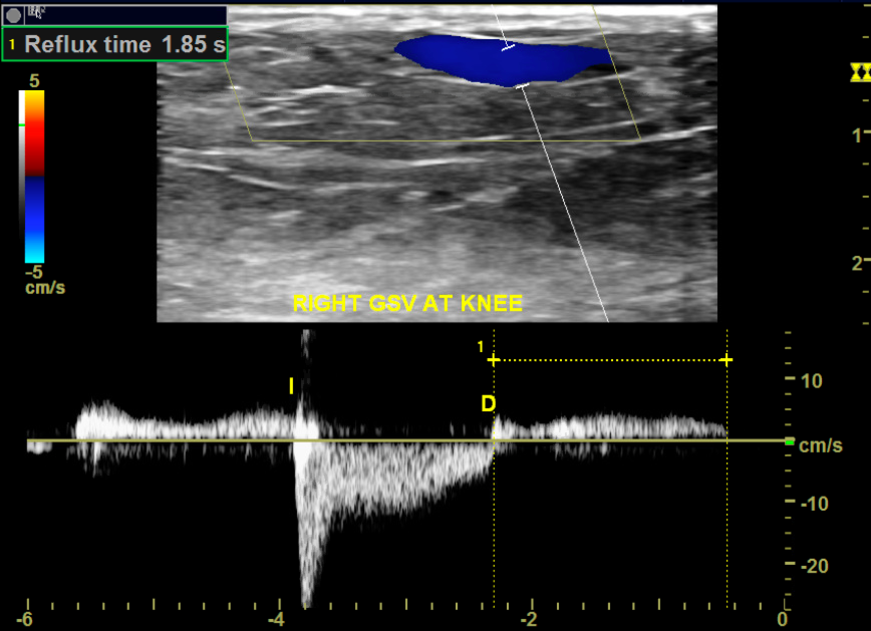 <p>Chronic Venous Insufficiency