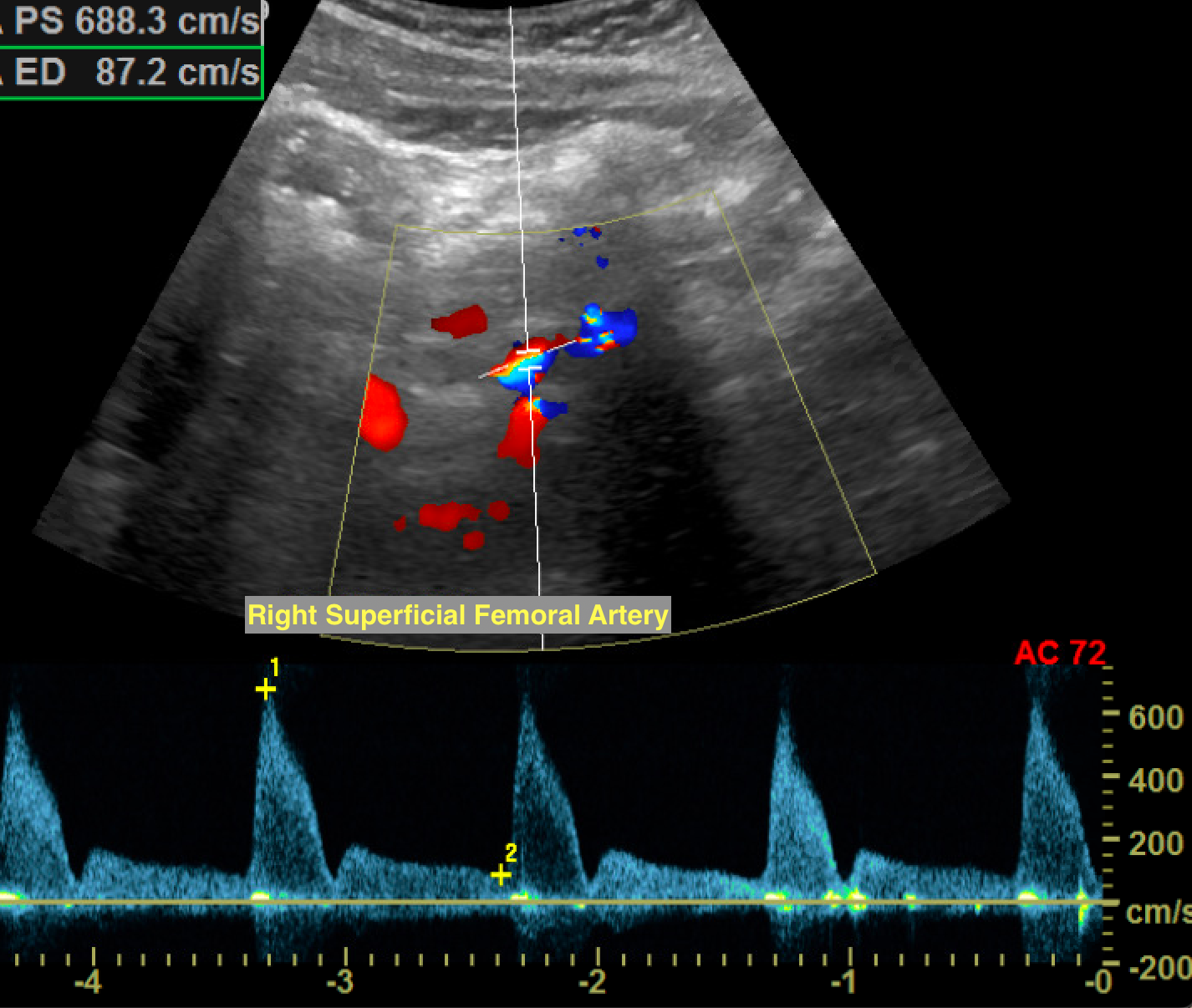 Hemodynamically Significant Stenosis with Turbulent Color Flow and Spectral Broadening