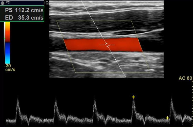 Doppler and spectral waveform of CCA.