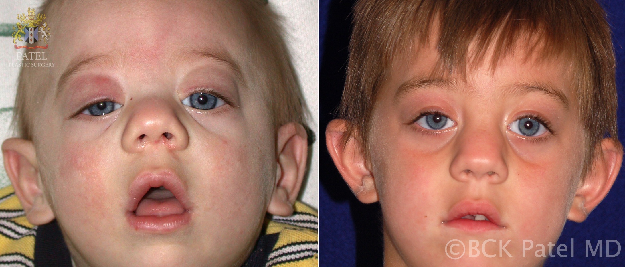 Congenital ptosis: severe bilateral congenital ptosis with the chin-up position and poor levator function with over action of the frontalis muscles