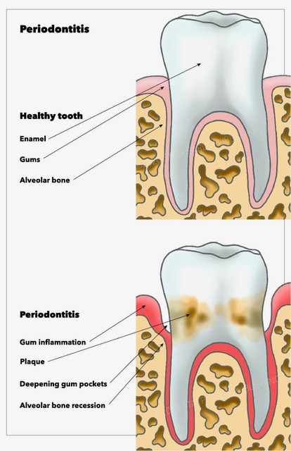 Periodontitis