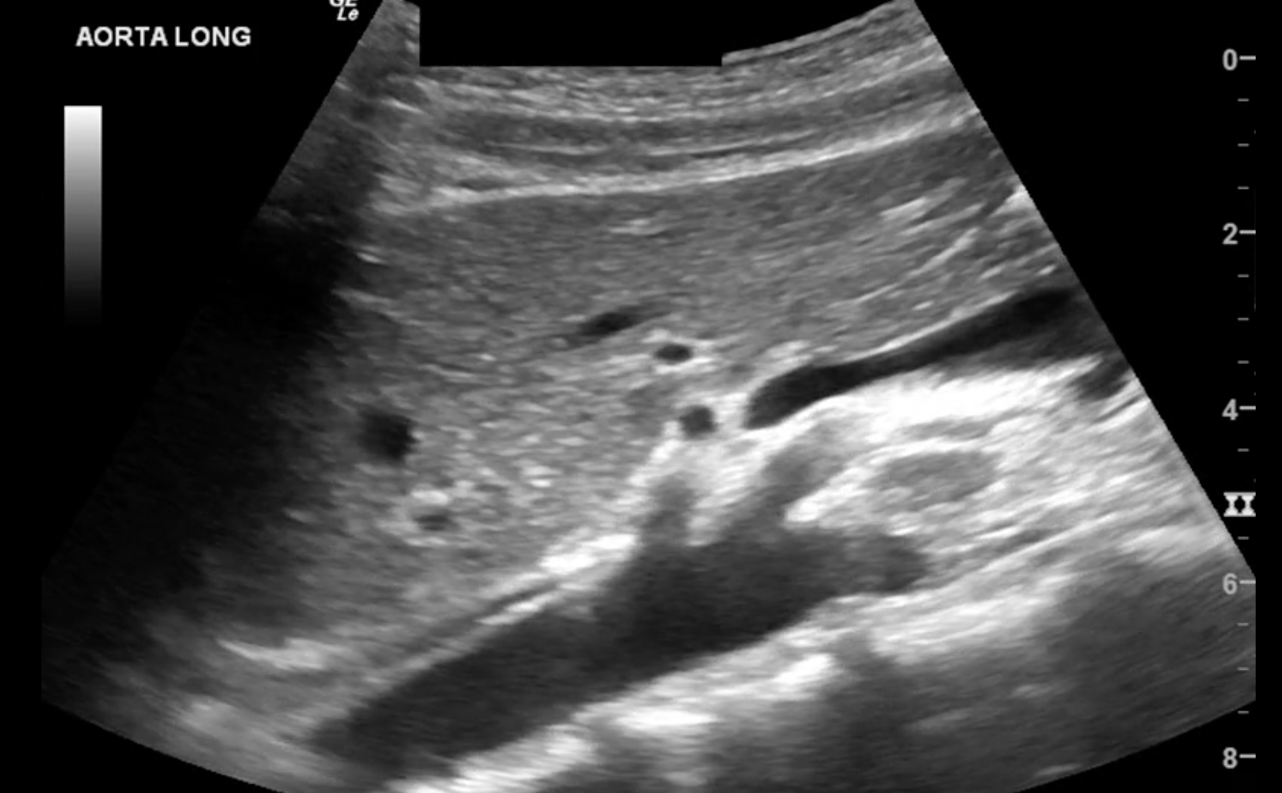 Sagittal image of the abdominal aorta