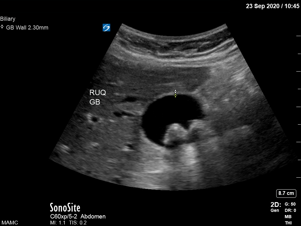 Gallbladder short axis with stones