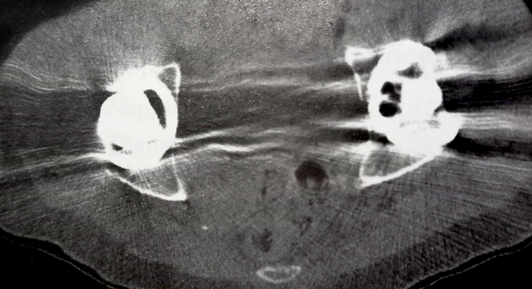 Metal artifacts CT scan