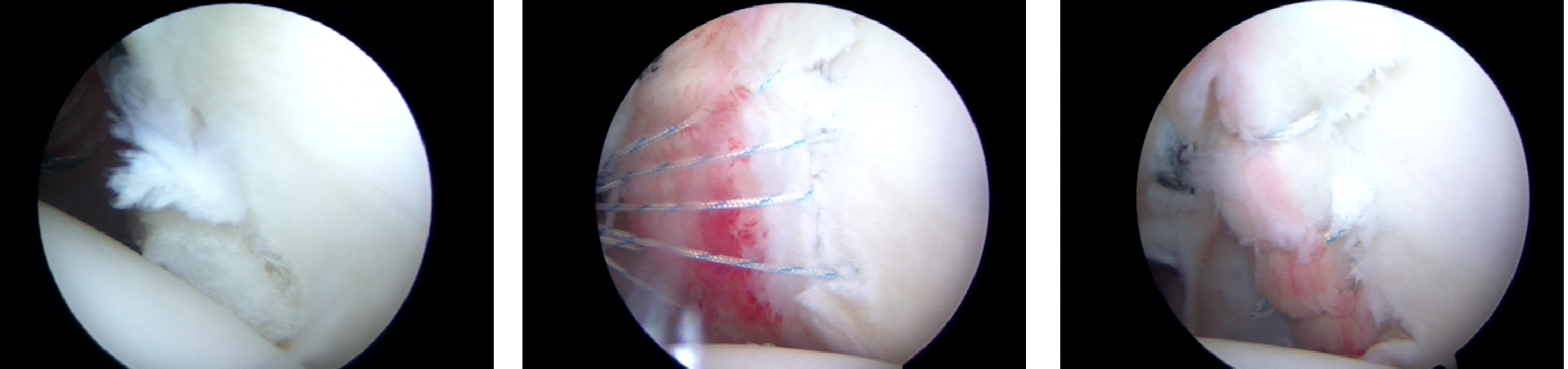 Arthroscopic View of Right Shoulder posterior Bankart tear associated with a posterior shoulder dislocation