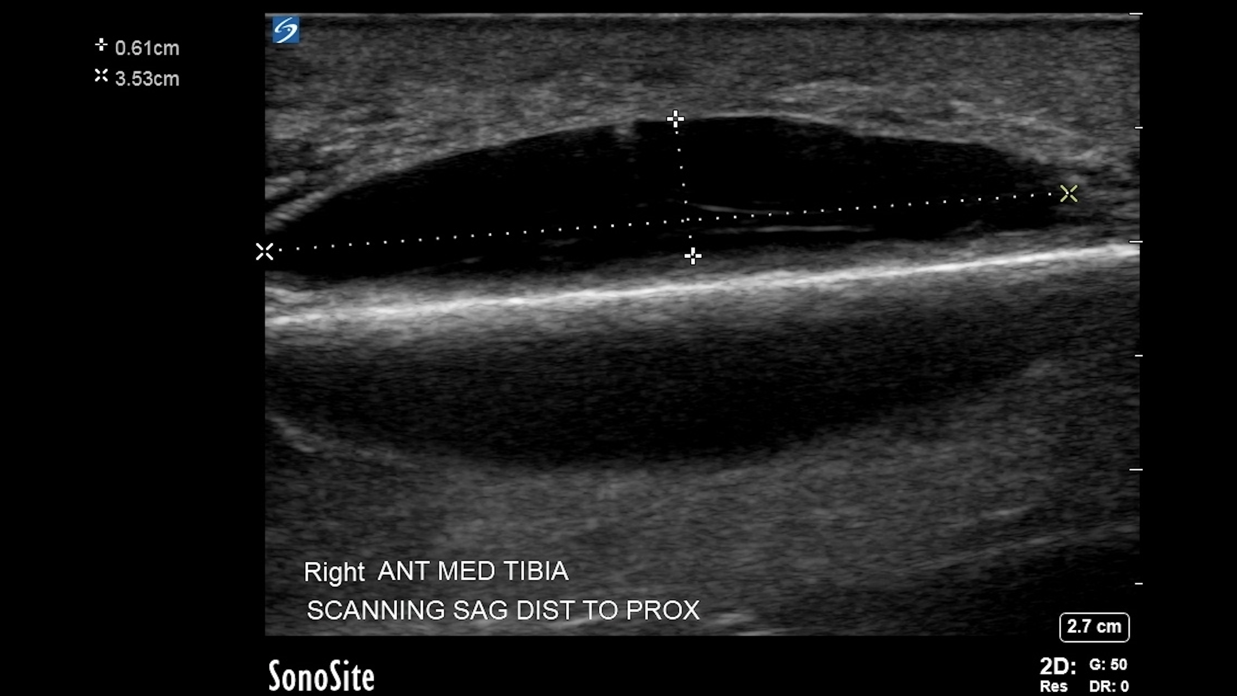 Mirror artifact along anterior tibia behind a developing hematoma.