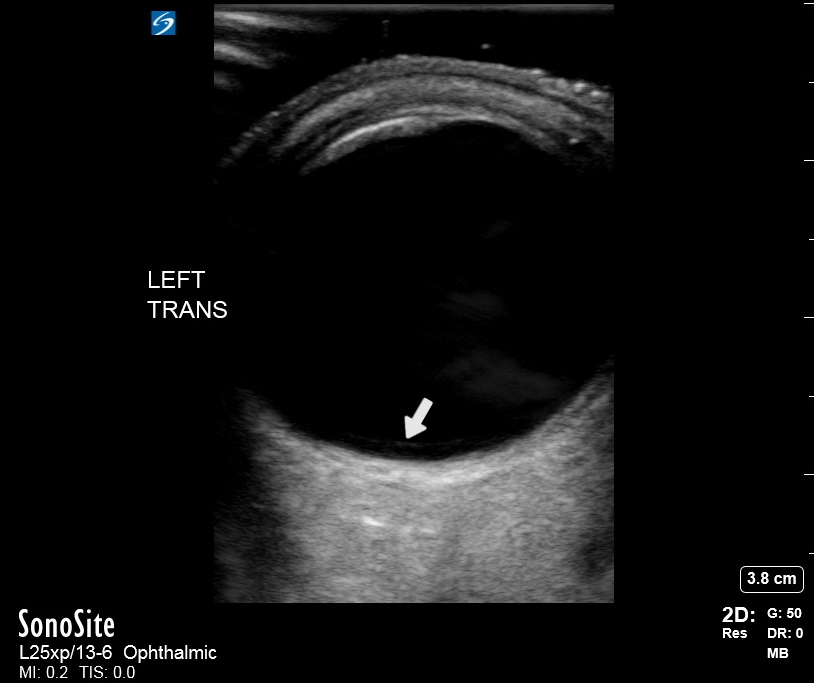 Posterior acoustic enhancement artifact behind the eye